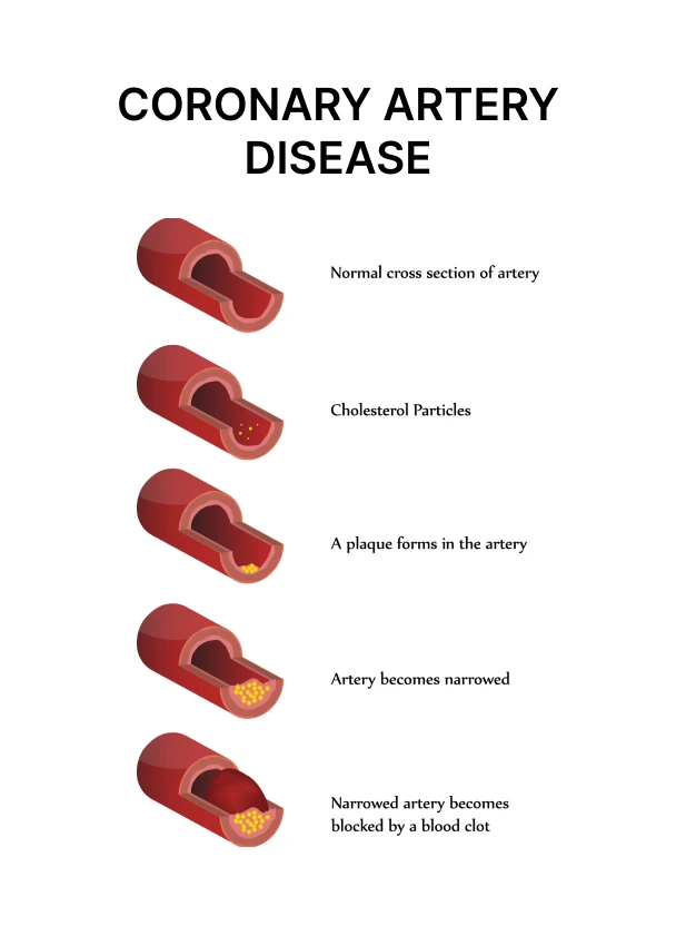 CORONARY ARTERY DISEASE - Best Cardiologist in East Delhi | Dr Gaurav ...