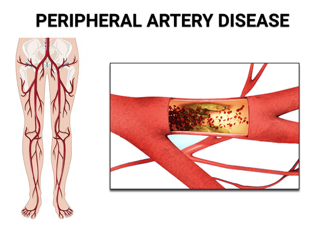 peripheral-artery-disease